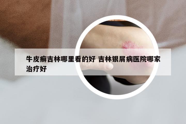牛皮癣吉林哪里看的好 吉林银屑病医院哪家治疗好