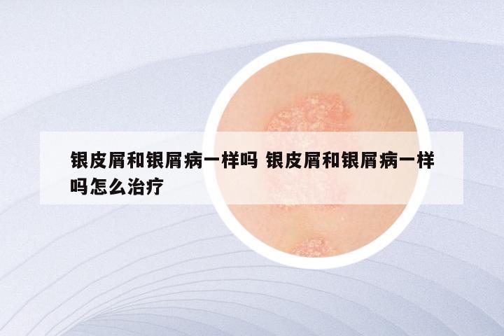 银皮屑和银屑病一样吗 银皮屑和银屑病一样吗怎么治疗