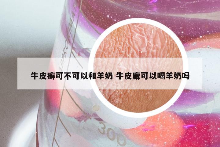 牛皮癣可不可以和羊奶 牛皮廨可以喝羊奶吗