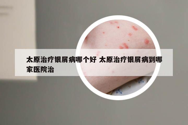 太原治疗银屑病哪个好 太原治疗银屑病到哪家医院治