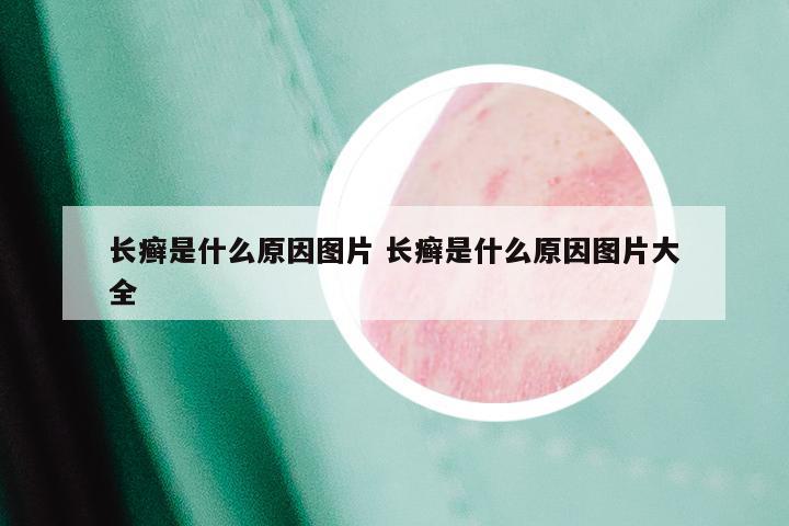 长癣是什么原因图片 长癣是什么原因图片大全
