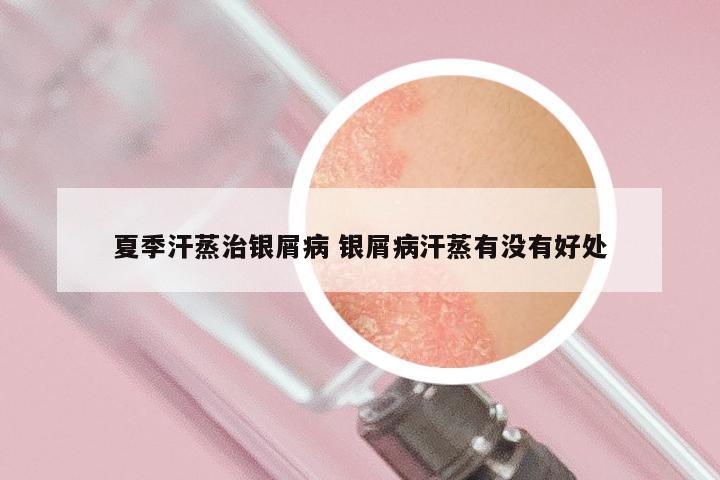 夏季汗蒸治银屑病 银屑病汗蒸有没有好处