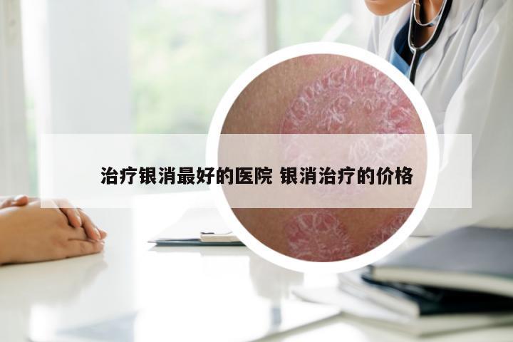 治疗银消最好的医院 银消治疗的价格