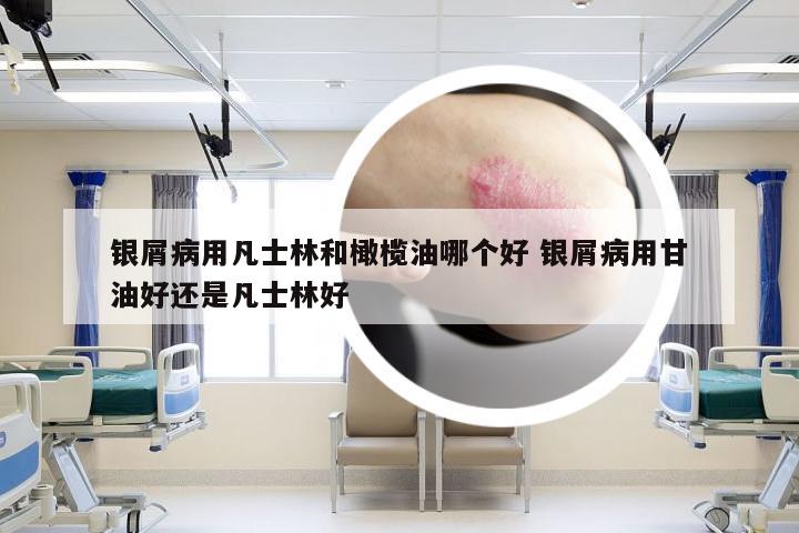 银屑病用凡士林和橄榄油哪个好 银屑病用甘油好还是凡士林好