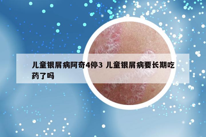 儿童银屑病阿奇4停3 儿童银屑病要长期吃药了吗