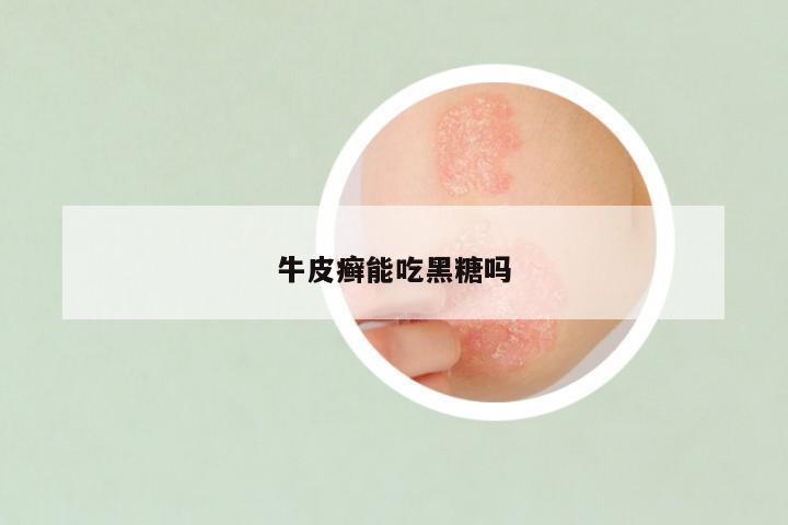 牛皮癣能吃黑糖吗