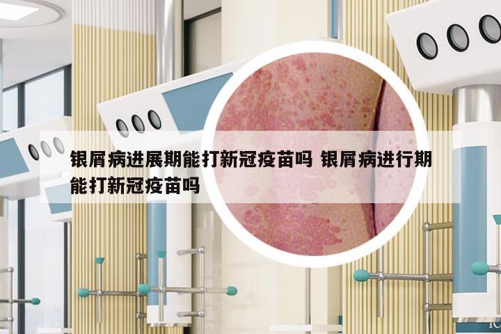 银屑病进展期能打新冠疫苗吗 银屑病进行期能打新冠疫苗吗