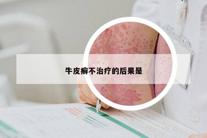 牛皮癣不治疗的后果是