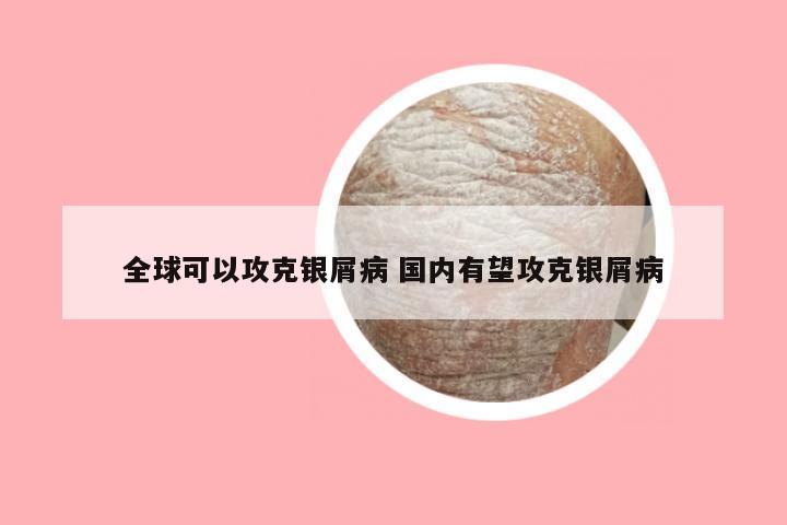 全球可以攻克银屑病 国内有望攻克银屑病
