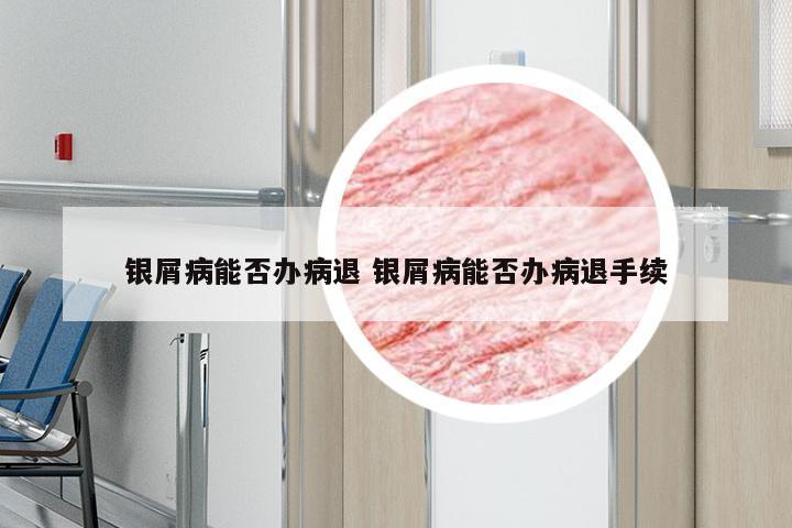 银屑病能否办病退 银屑病能否办病退手续