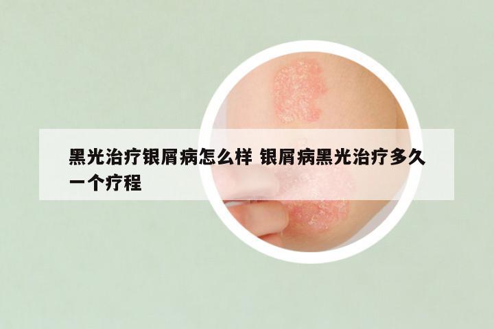 黑光治疗银屑病怎么样 银屑病黑光治疗多久一个疗程