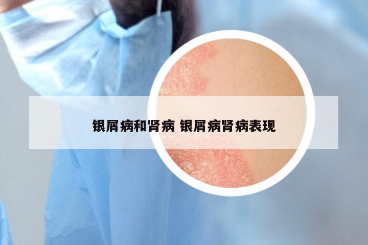 银屑病和肾病 银屑病肾病表现