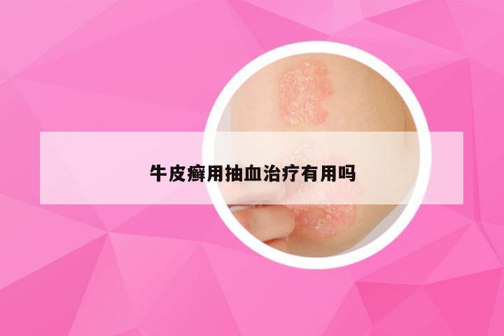 牛皮癣用抽血治疗有用吗