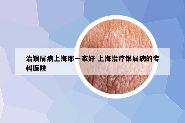 治银屑病上海那一家好 上海治疗银屑病的专科医院