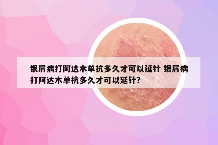 银屑病打阿达木单抗多久才可以延针 银屑病打阿达木单抗多久才可以延针?
