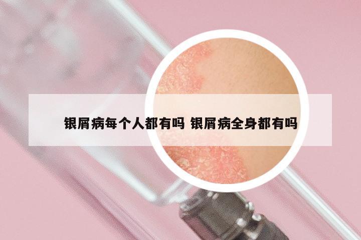 银屑病每个人都有吗 银屑病全身都有吗