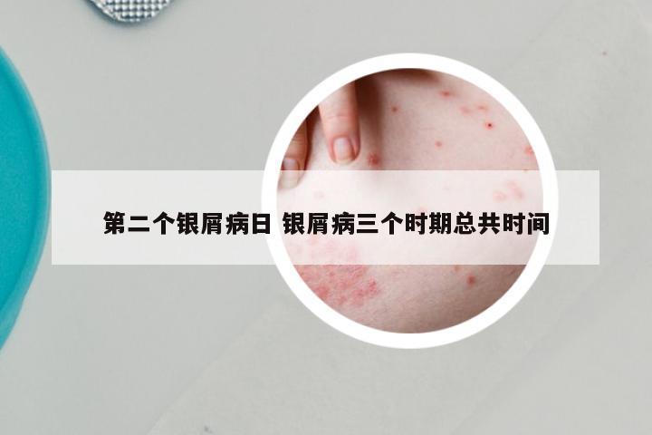 第二个银屑病日 银屑病三个时期总共时间