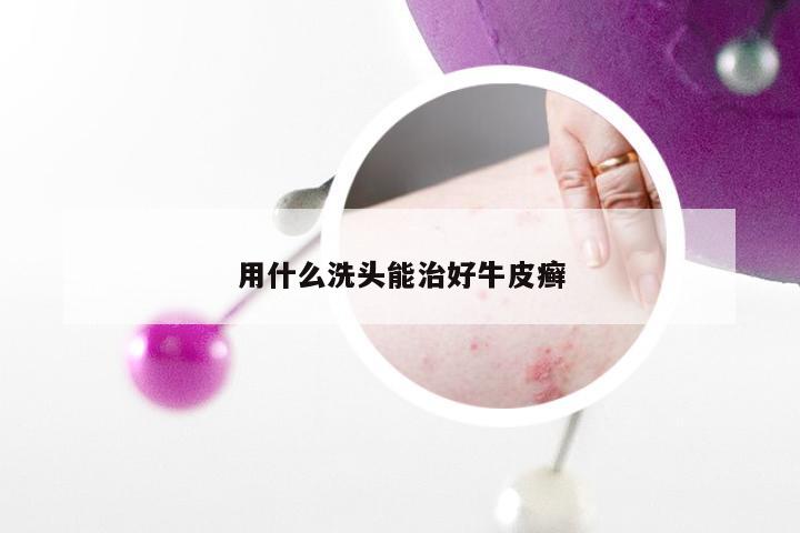 用什么洗头能治好牛皮癣