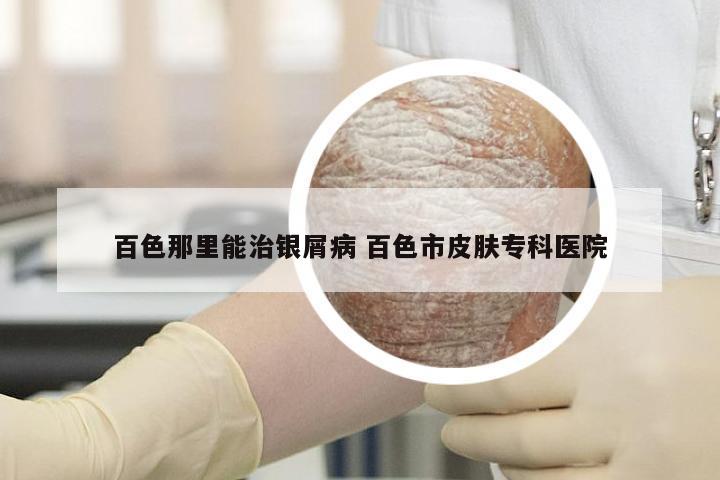 百色那里能治银屑病 百色市皮肤专科医院