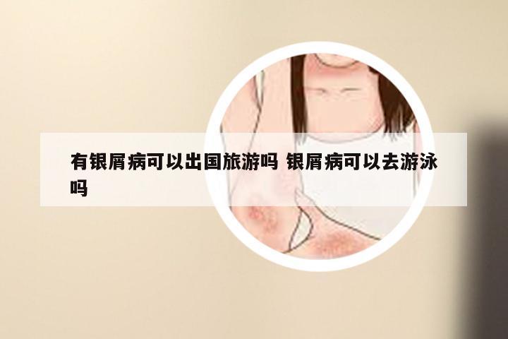 有银屑病可以出国旅游吗 银屑病可以去游泳吗