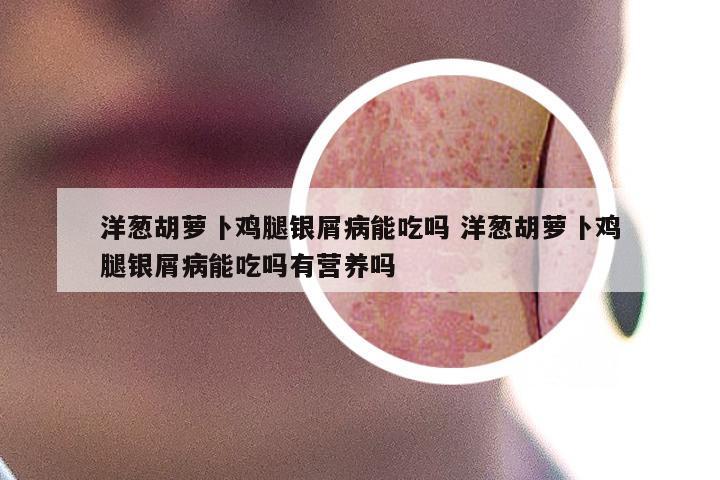 洋葱胡萝卜鸡腿银屑病能吃吗 洋葱胡萝卜鸡腿银屑病能吃吗有营养吗