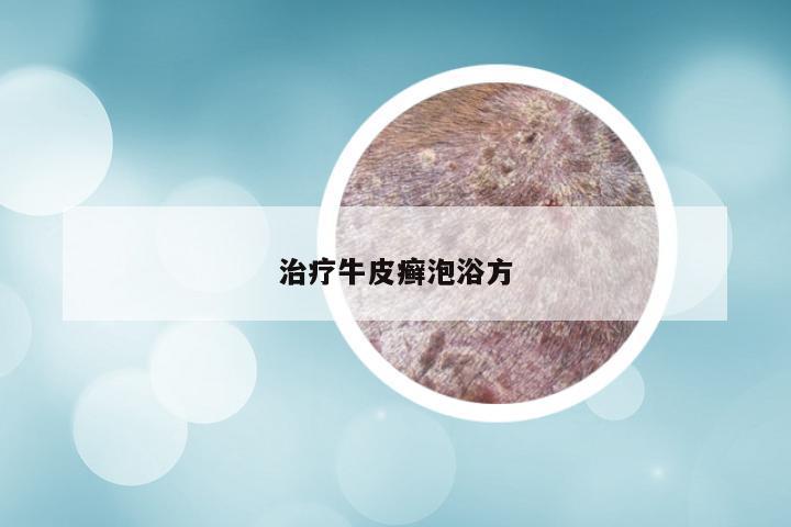 治疗牛皮癣泡浴方