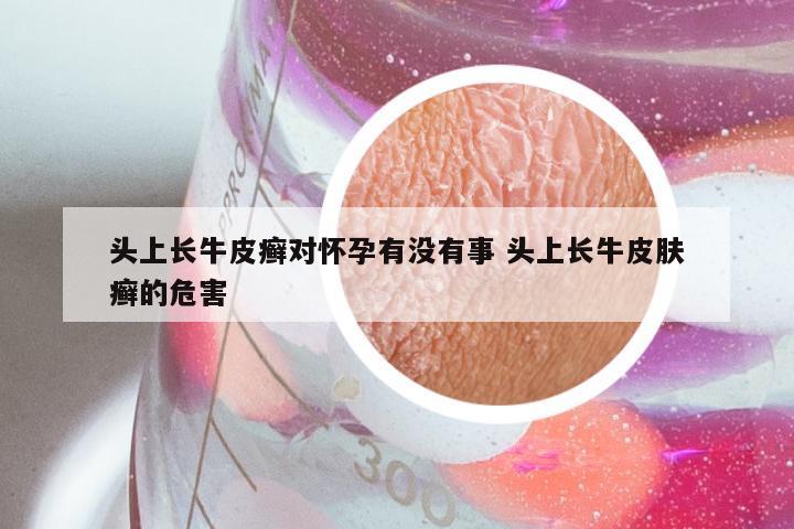 头上长牛皮癣对怀孕有没有事 头上长牛皮肤癣的危害