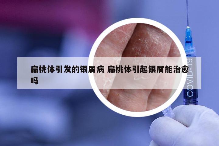 扁桃体引发的银屑病 扁桃体引起银屑能治愈吗