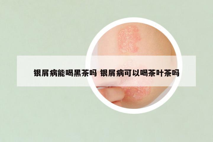 银屑病能喝黑茶吗 银屑病可以喝茶叶茶吗