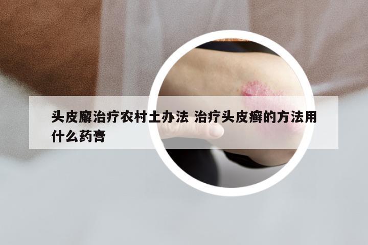 头皮廨治疗农村土办法 治疗头皮癣的方法用什么药膏