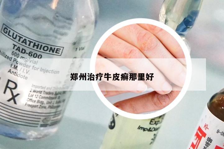 郑州治疗牛皮癣那里好