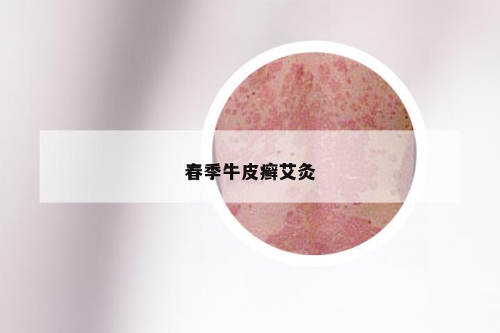 春季牛皮癣艾灸