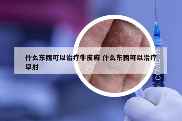 什么东西可以治疗牛皮癣 什么东西可以治疗早射