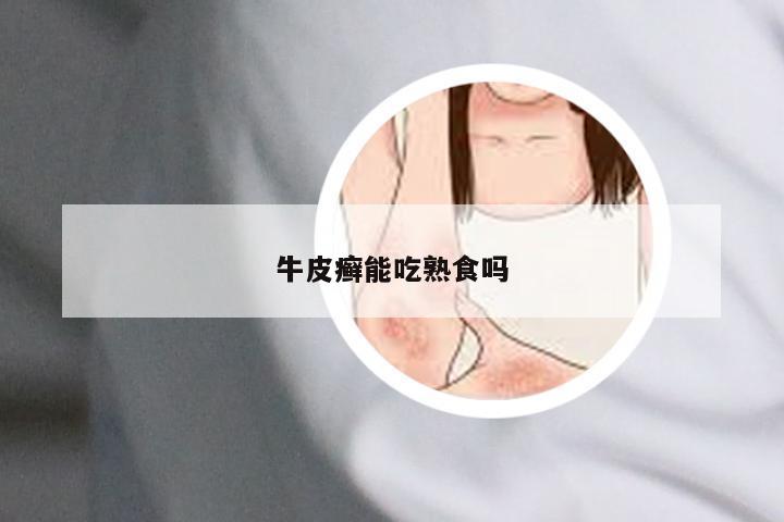 牛皮癣能吃熟食吗