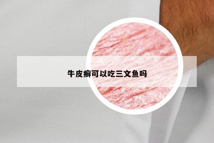 牛皮癣可以吃三文鱼吗