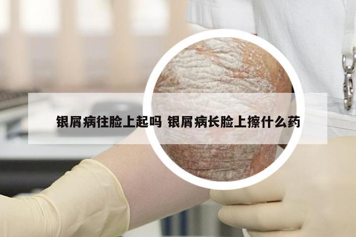银屑病往脸上起吗 银屑病长脸上擦什么药