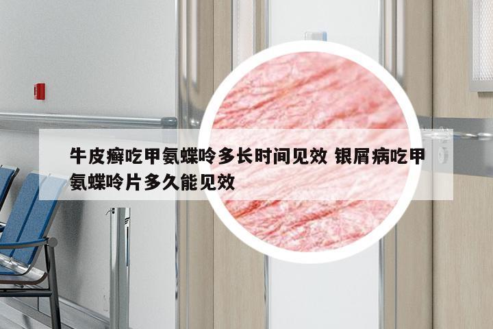 牛皮癣吃甲氨蝶呤多长时间见效 银屑病吃甲氨蝶呤片多久能见效