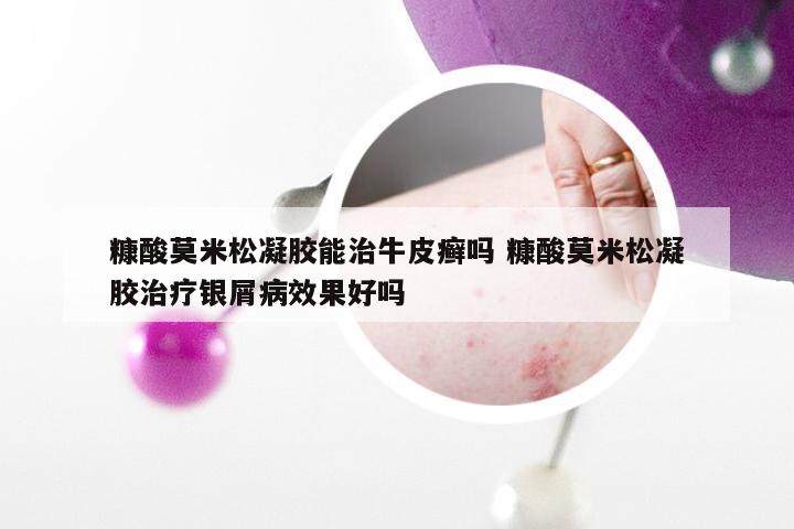 糠酸莫米松凝胶能治牛皮癣吗 糠酸莫米松凝胶治疗银屑病效果好吗