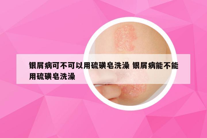 银屑病可不可以用硫磺皂洗澡 银屑病能不能用硫磺皂洗澡