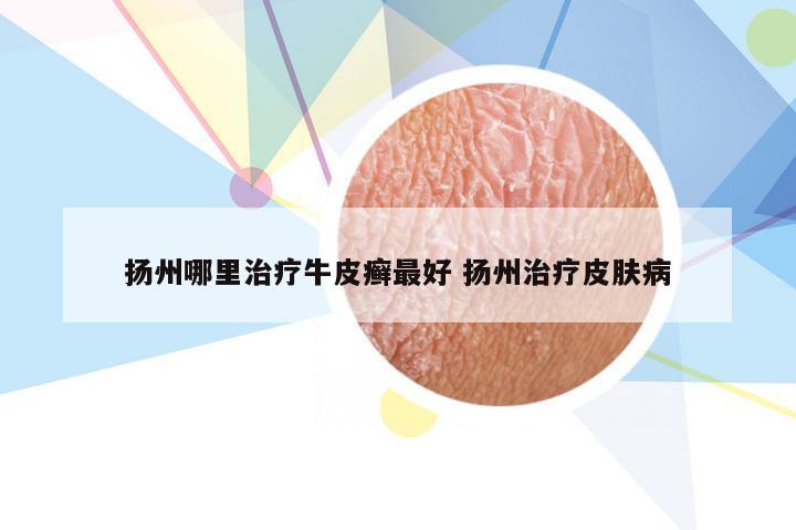 扬州哪里治疗牛皮癣最好 扬州治疗皮肤病