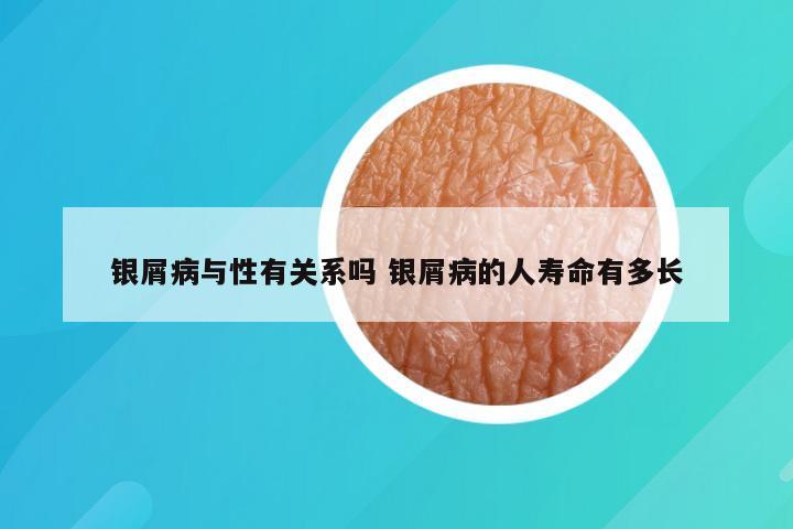 银屑病与性有关系吗 银屑病的人寿命有多长