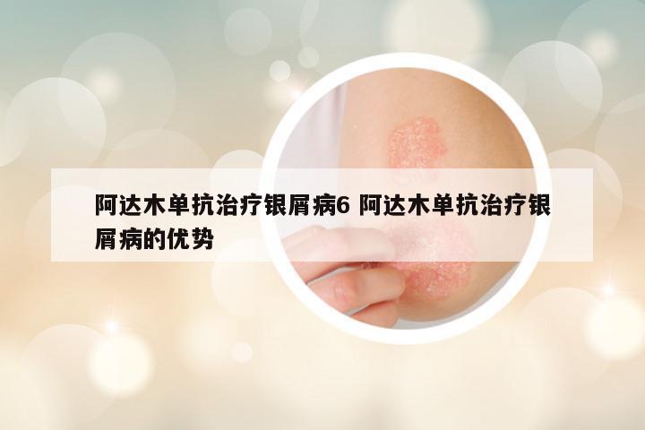 阿达木单抗治疗银屑病6 阿达木单抗治疗银屑病的优势