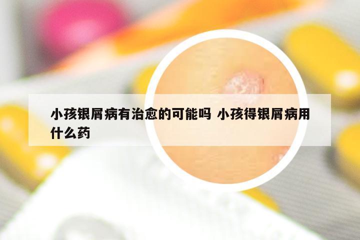 小孩银屑病有治愈的可能吗 小孩得银屑病用什么药