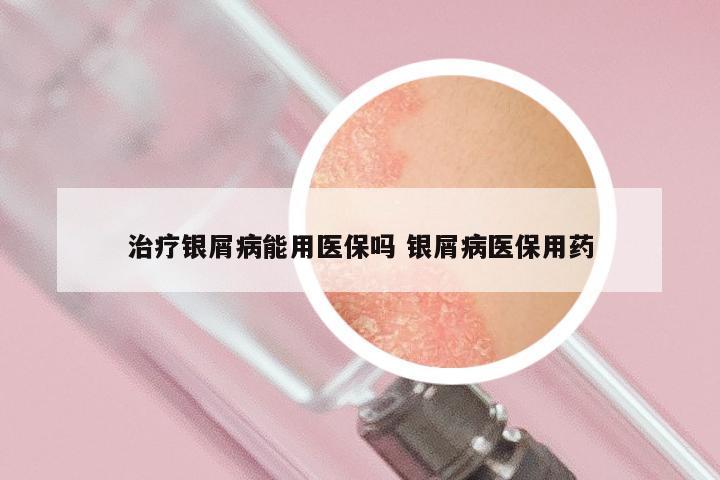 治疗银屑病能用医保吗 银屑病医保用药