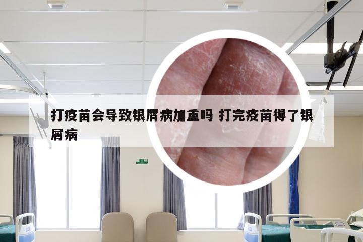 打疫苗会导致银屑病加重吗 打完疫苗得了银屑病