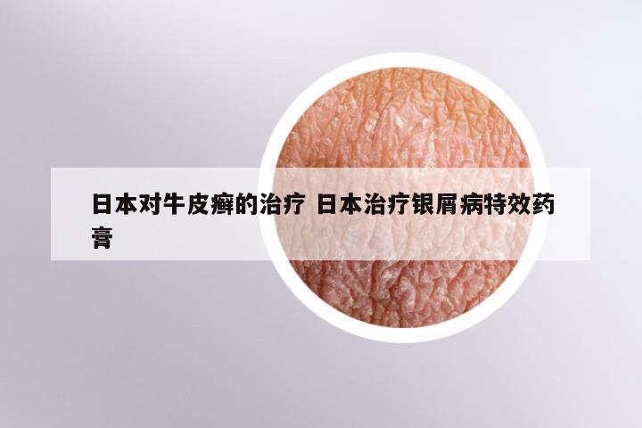 日本对牛皮癣的治疗 日本治疗银屑病特效药膏