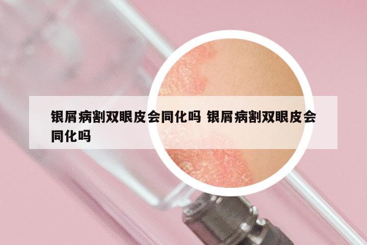 银屑病割双眼皮会同化吗 银屑病割双眼皮会同化吗