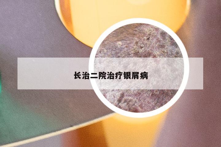 长治二院治疗银屑病