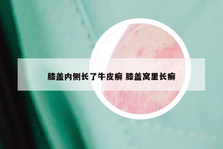 膝盖内侧长了牛皮癣 膝盖窝里长癣