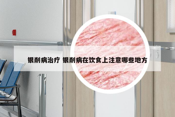 银削病治疗 银削病在饮食上注意哪些地方
